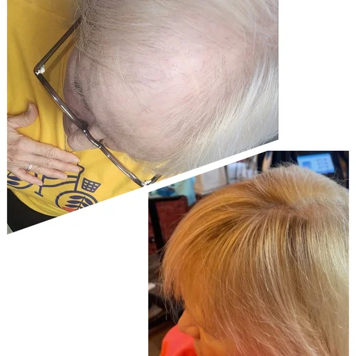 Hair Loss & Scalp Recovery Program (In-Person)