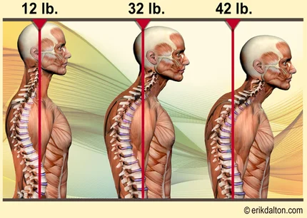 Posture Assessment & Rehab Plan