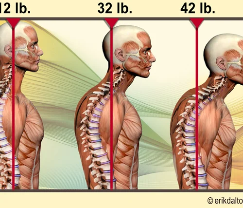 Posture Assessment & Rehab Plan