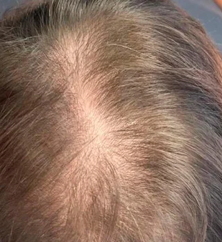 Hair Restoration