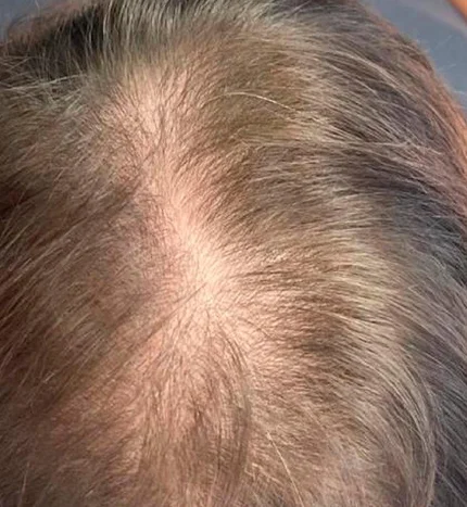 Hair Restoration  (initial consult and one month treatment plan)