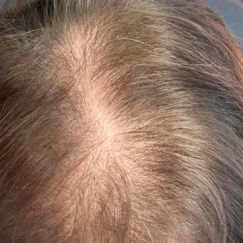 Hair Restoration