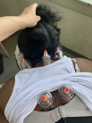Cupping add on 