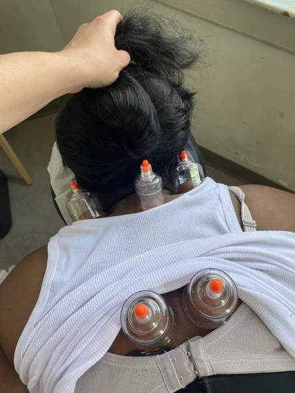 Cupping add on 