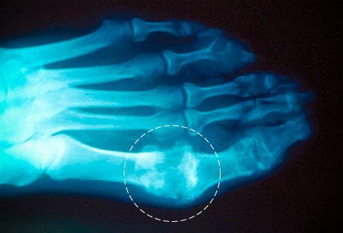 Avoid permanent joint damage from gout